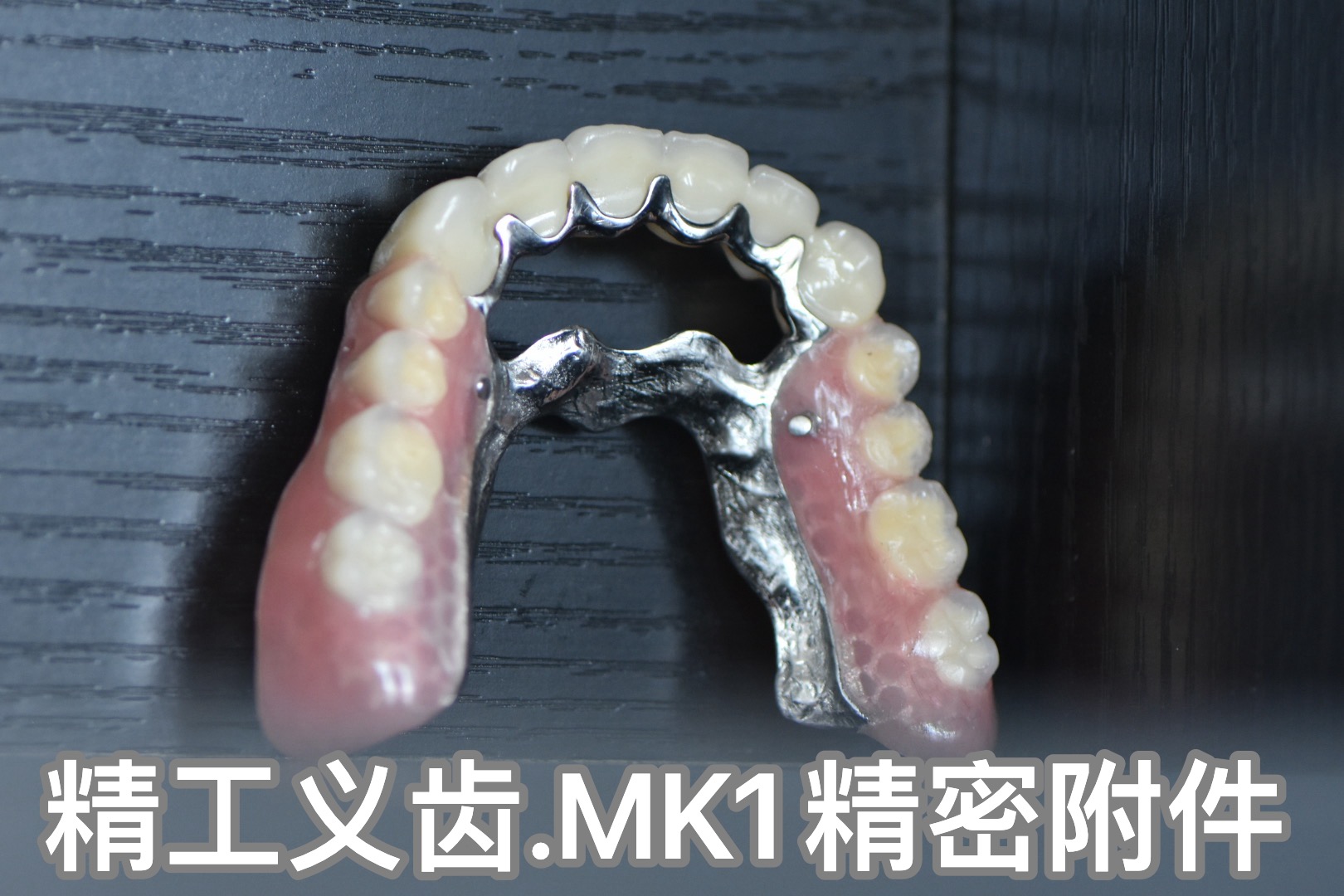 精工义齿-MK1精密附件